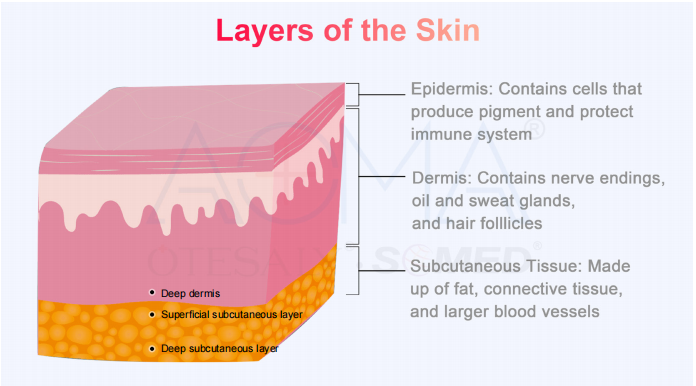 皮层中的 PLLA 填充剂