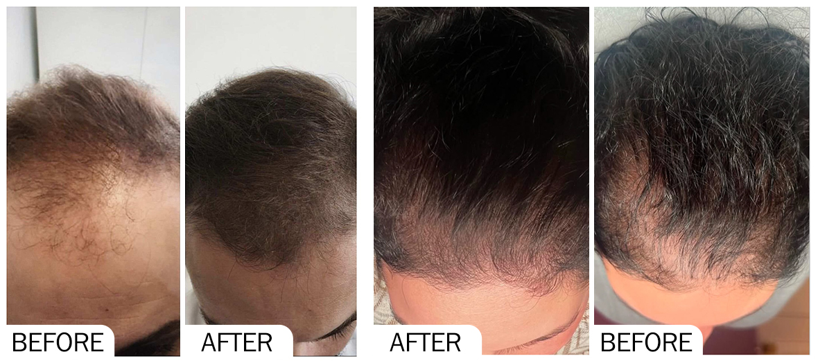 Before & After pictures of AOMA HAIR GROWTH AOMA HAIR GROWTH 前后对比图