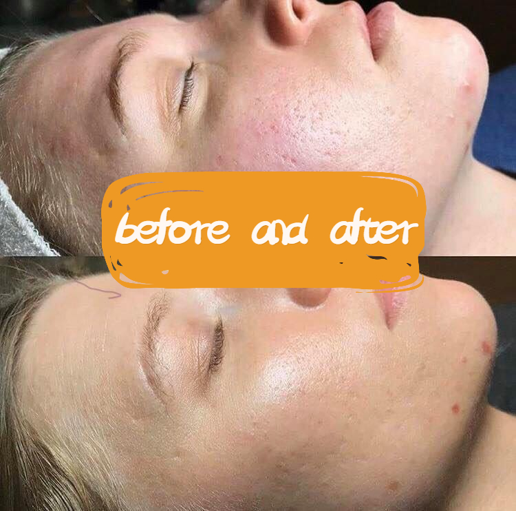 AOMA Skin Rejuvenation Before-and-after AOMA 嫩肤术前后对比