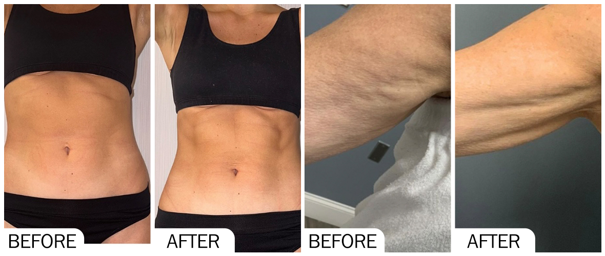 Before & After pictures of AOMA Fat-X solution AOMA Fat-X 解决方案前后对比图