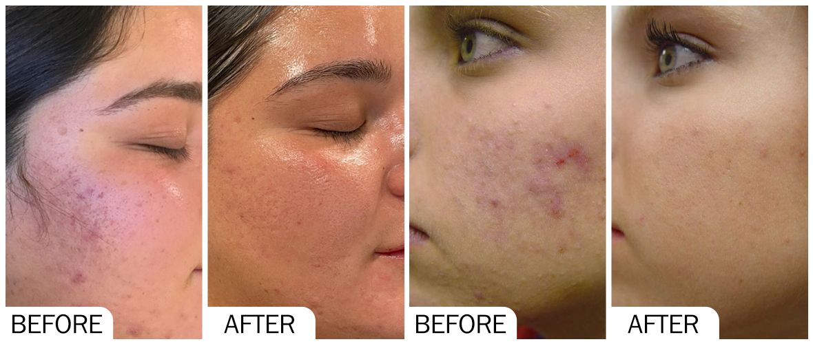 AOMA Before and After Skin Rejuvenation AOMA 嫩肤前后对比