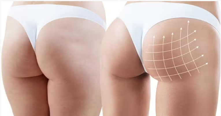 PLLA 填充剂增强前后