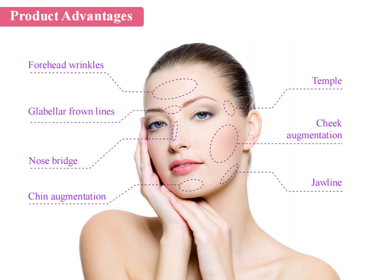 Hyaluronic Acid Fillers Area Display Diagram 玻尿酸填充区域展示图