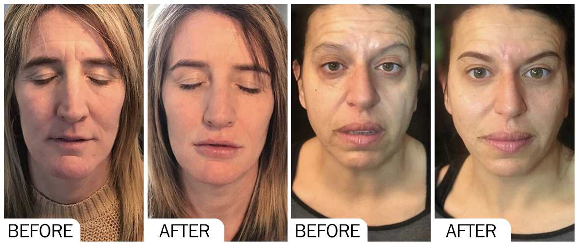 Before and After Facial Filler AOMA 面部填充前后对比 AOMA