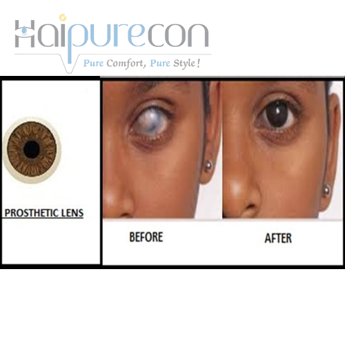 prosthetic lenses العدسات الاصطناعية