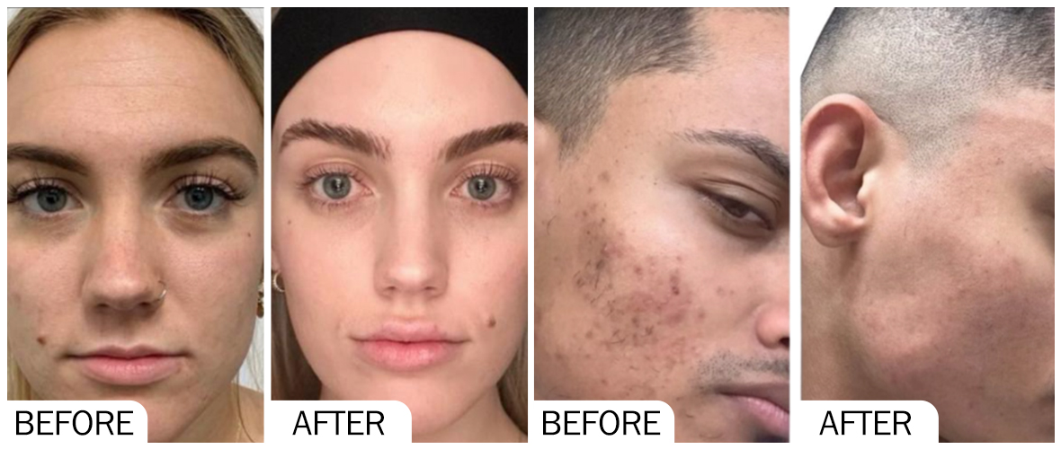 Before & After pictures of AOMA MESO AOMA MESO 之前和之后的照片