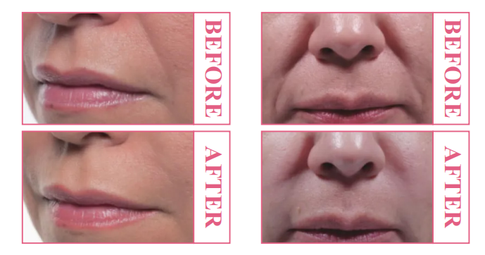 Natural-Looking Facial Rejuvenation 自然面部年轻化