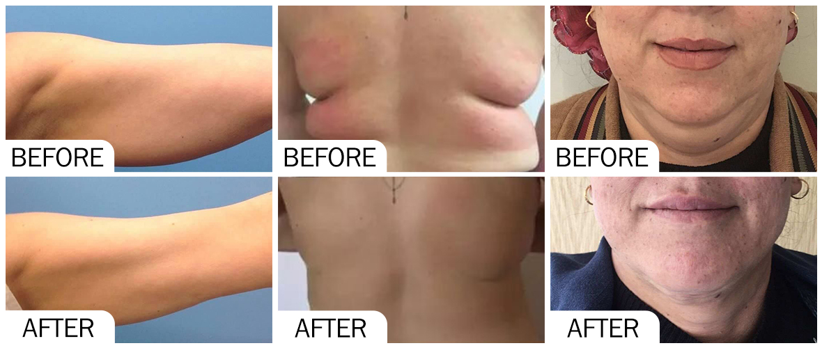 Before and After Fat Dissolving AOMA AOMA溶脂前后对比