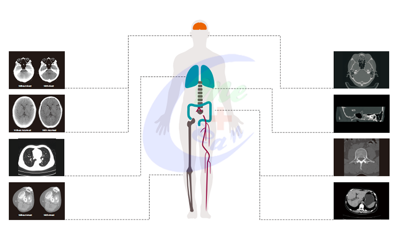 I-MCI0247 CT Scan Brain Machine interface