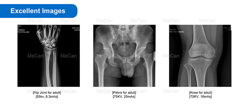 Izithombe Ezinhle Kakhulu ze-Digital Mobile Radiography MX-DR056A14