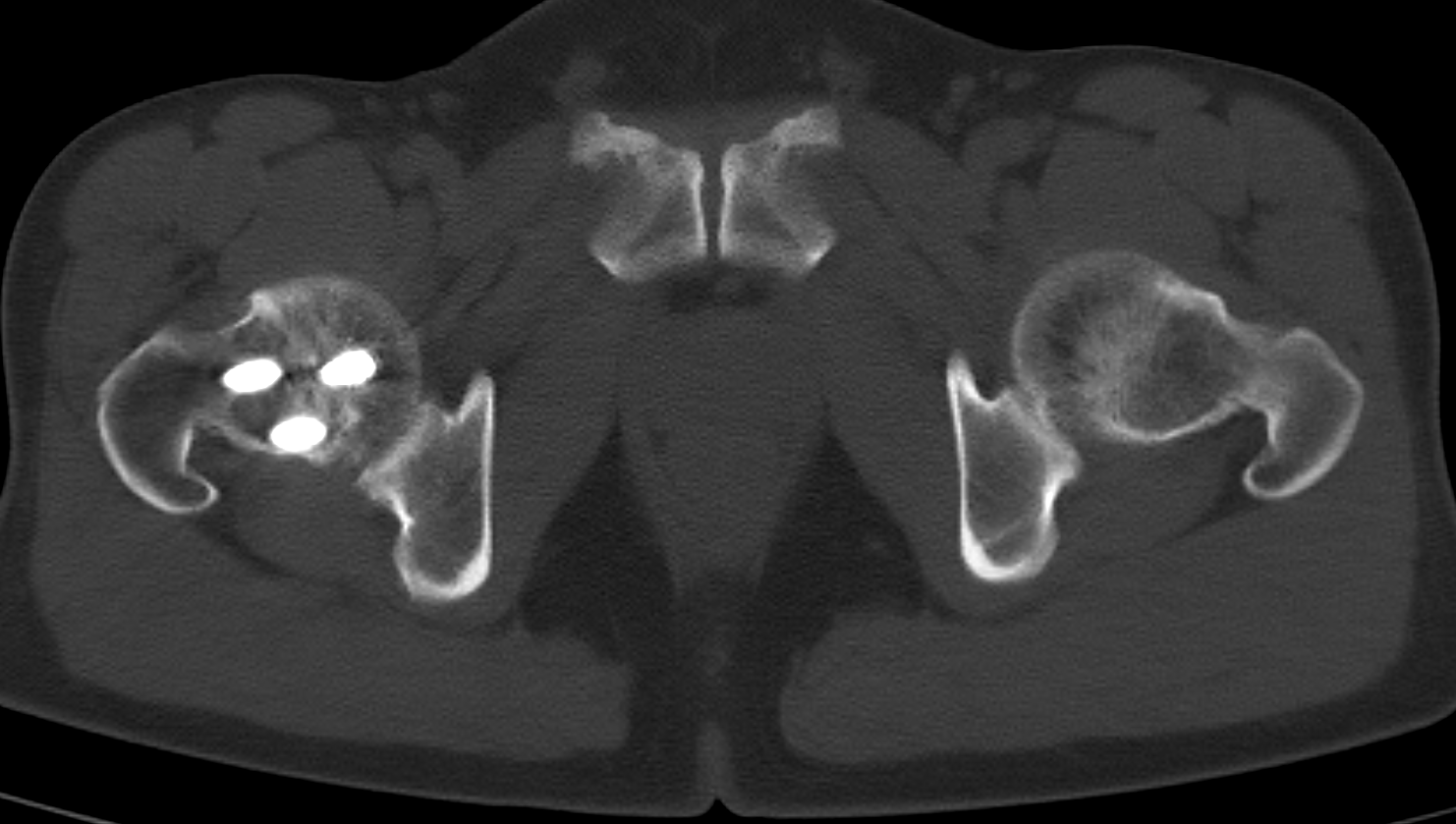 CT Scan Image of Hip Joints Obraz tomografii komputerowej stawów biodrowych