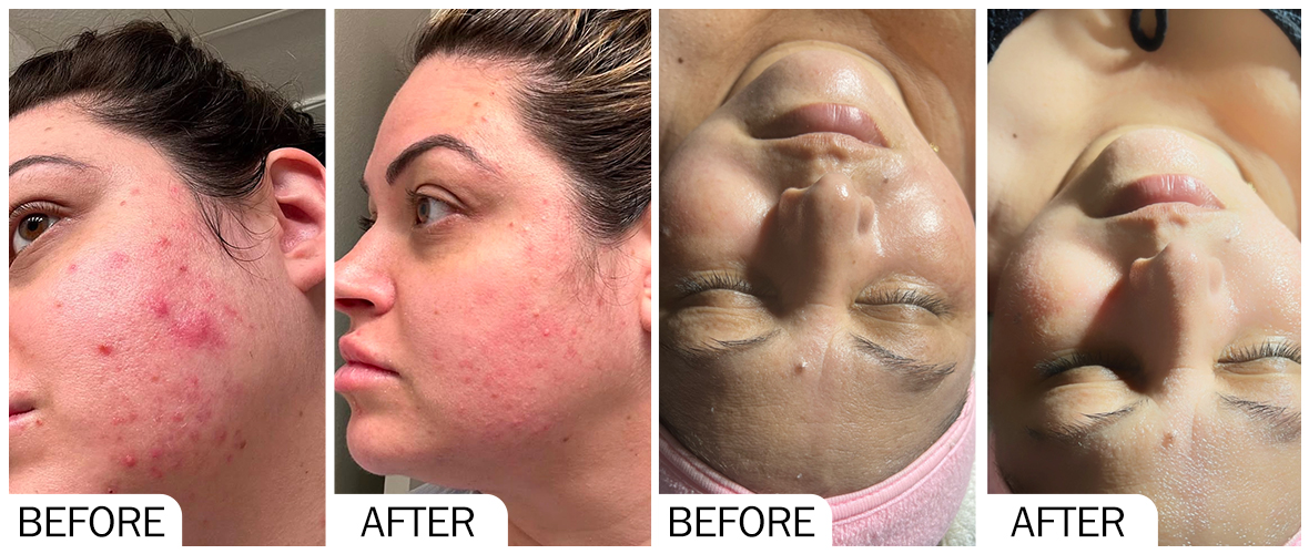 SKINBOOSTER AOMA 之前和之後