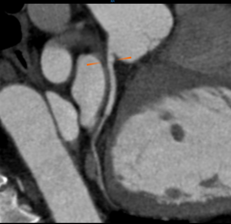 Angiografia CT (CTA) Skanowanie tętnicy wieńcowej (2)